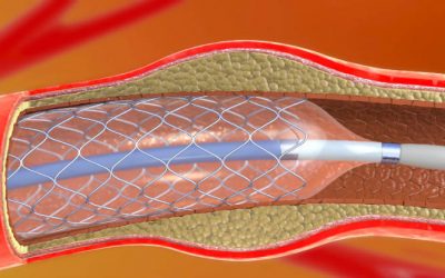 What are stents and what are they used for in cardiology?